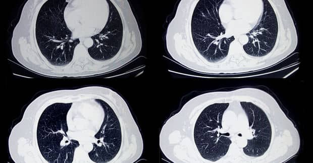 Artificial Intelligence Can Now Accurately Diagnose Cancer