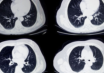 A CT scan of a lung