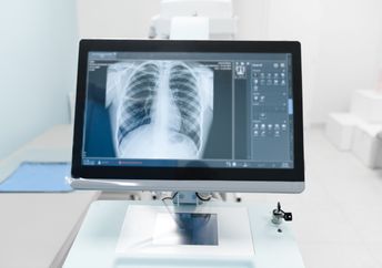 A chest X-ray on a medical monitor.