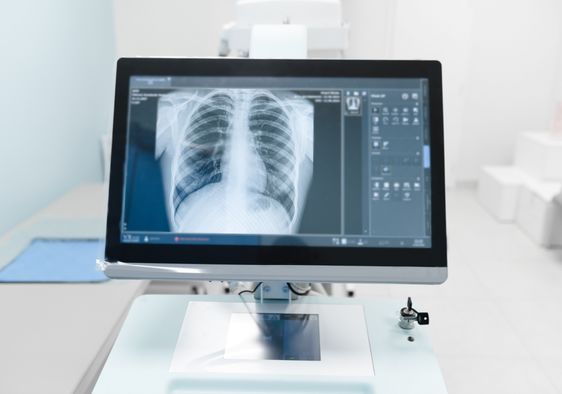 A chest X-ray on a medical monitor.