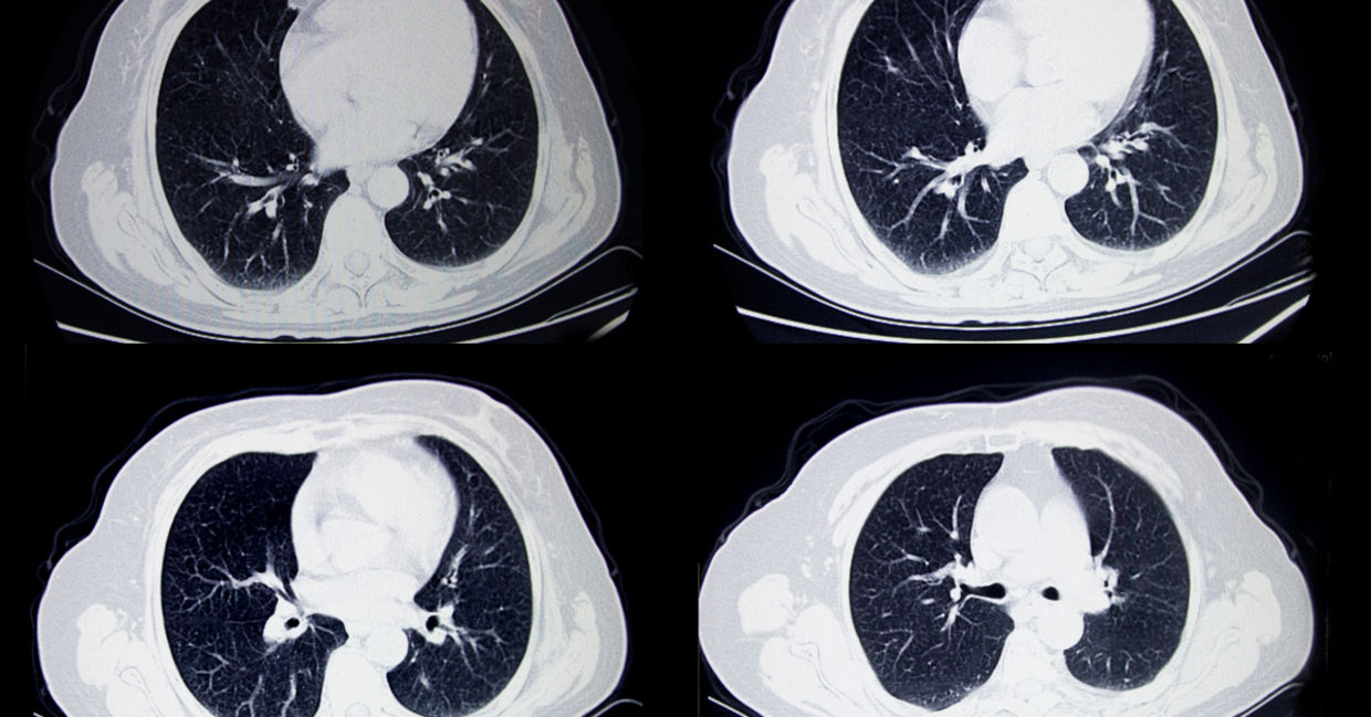 A CT scan of a lung