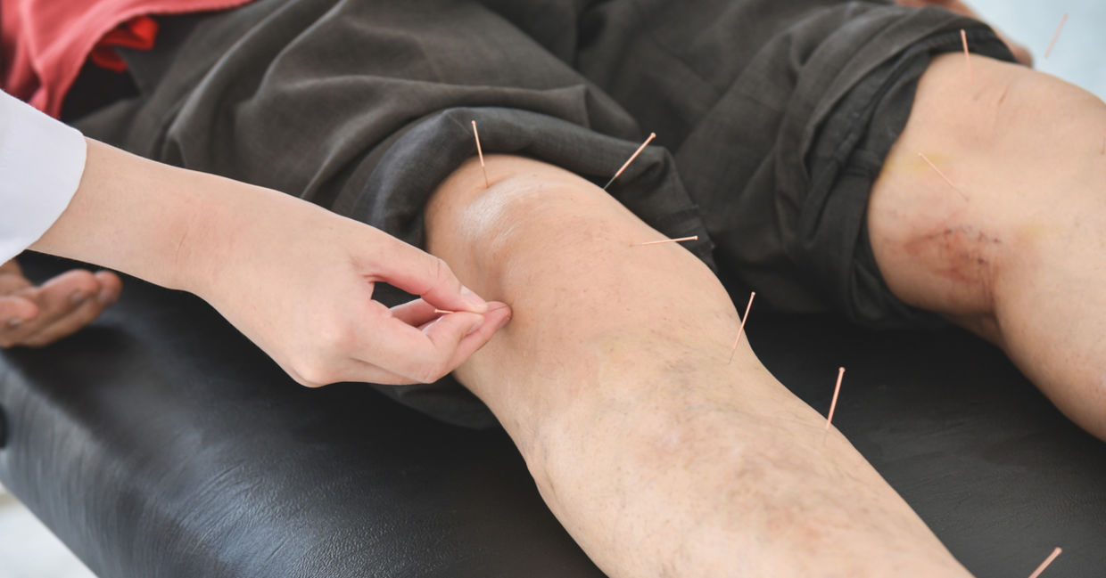 Healing acupuncture for relief from knee and leg pain.