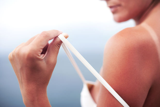 Sunburn on shoulder