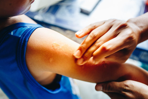 Bug bite covered in ointment